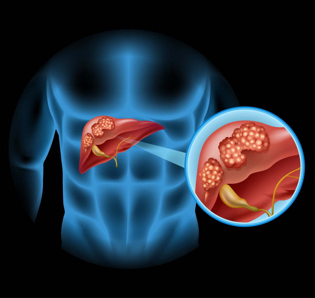 KARACİĞER KANSERİ