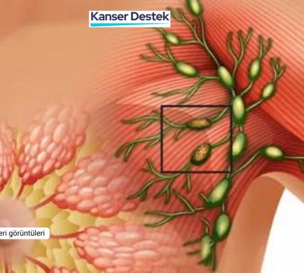 Lenf kanseri görüntüleri