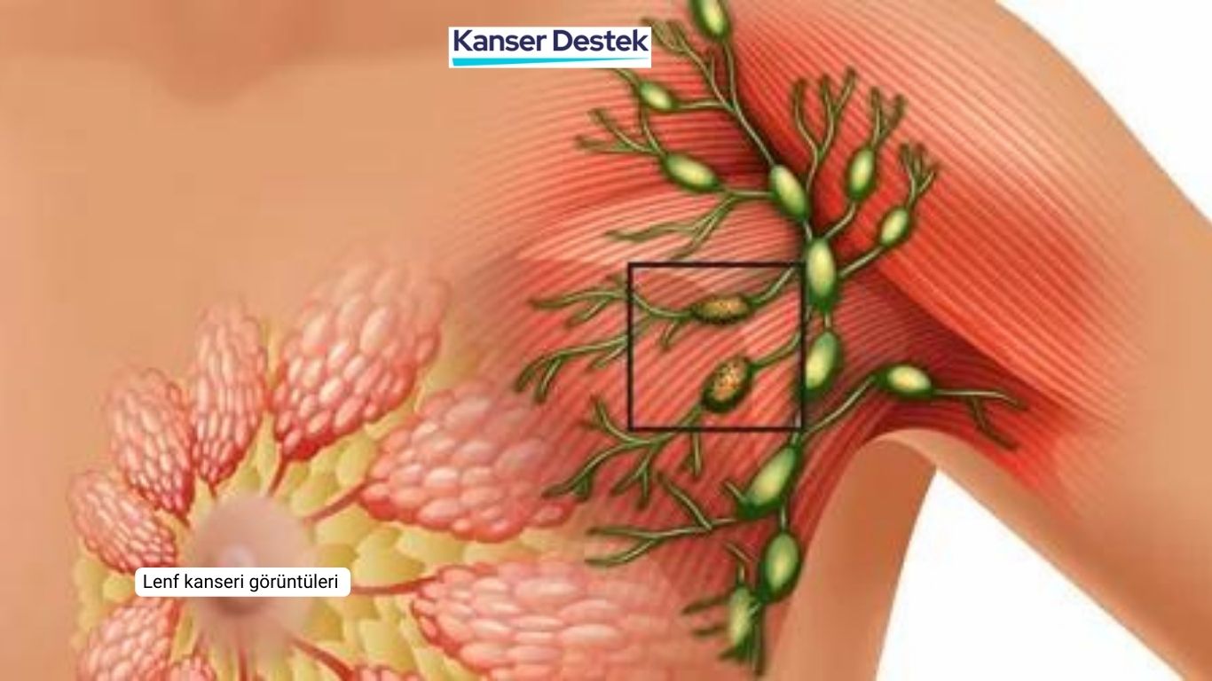 Lenf Kanseri Görüntüleri 3. Evre  ve Tedavisi