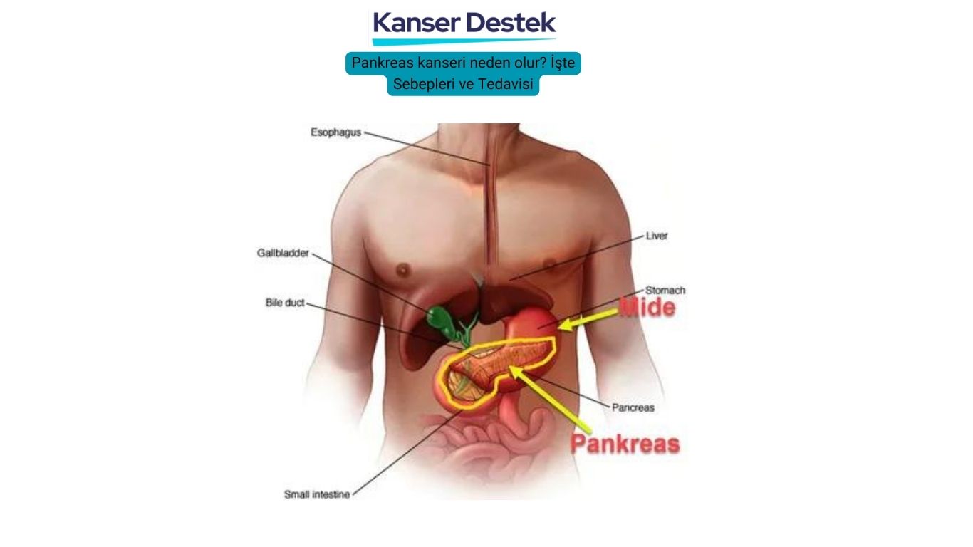 Pankreas kanseri neden olur ve tedavisi için 3 yol