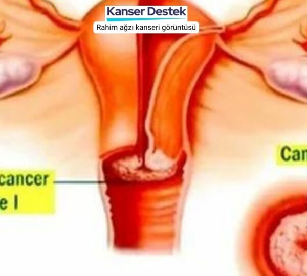 Rahim ağzı kanseri görüntüsü