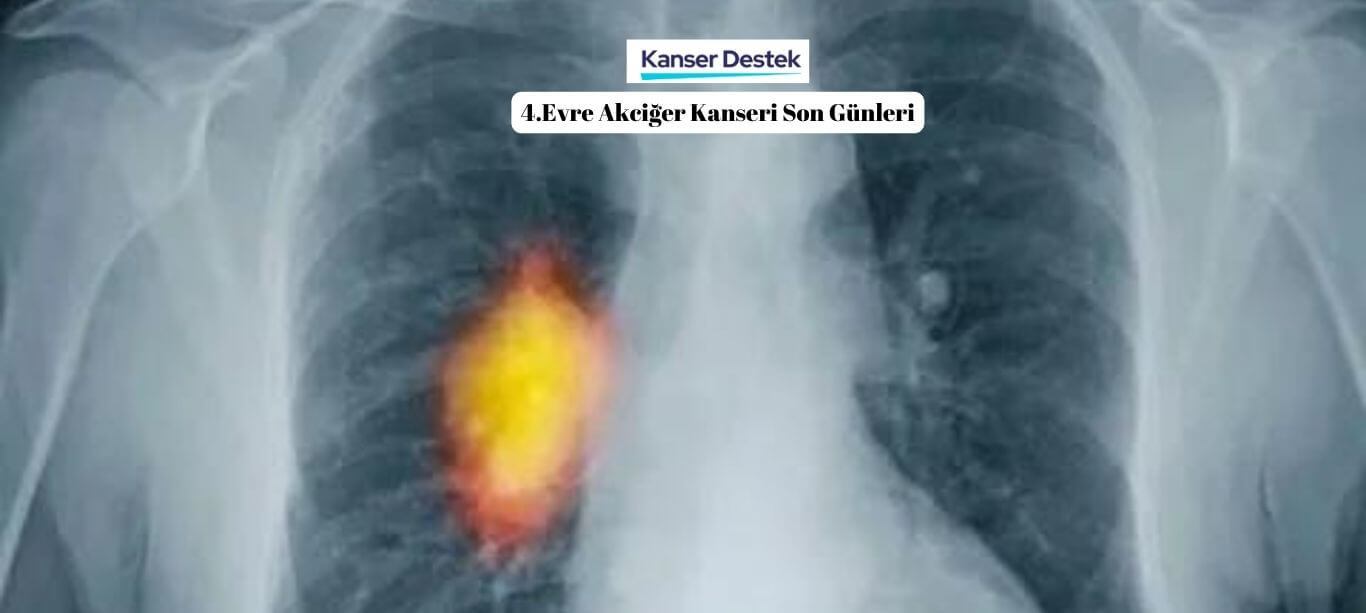 4. Evre Akciğer Kanseri Son Dönemleri İçin Önemli Notlar!