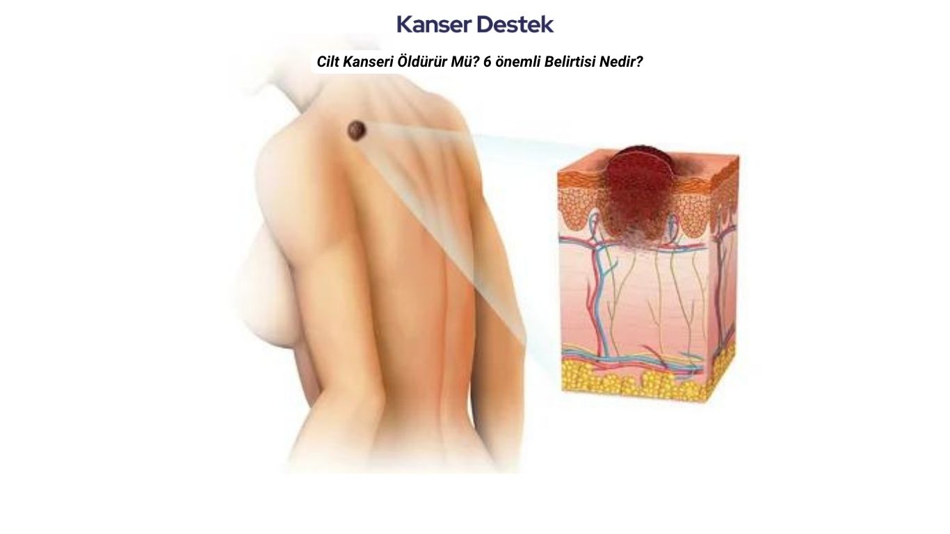 Cilt Kanseri Öldürür Mü? İşte 6 Önemli Belirtisi