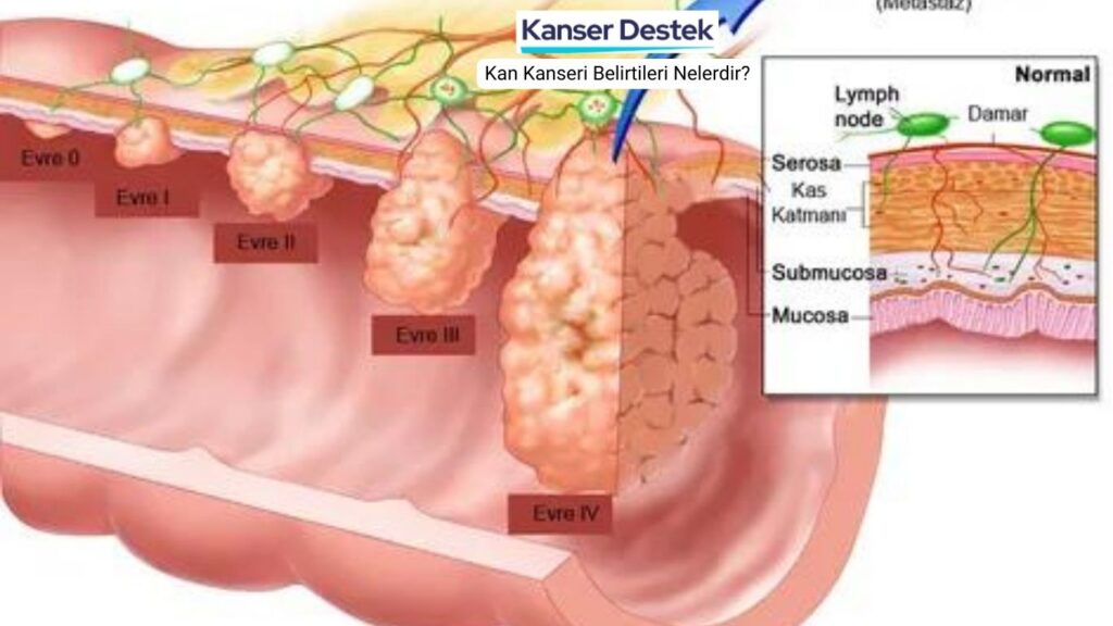 Kan Kanseri Belirtileri Nelerdir?