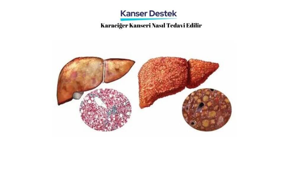 Karaciğer Kanseri Nasıl Tedavi Edilir