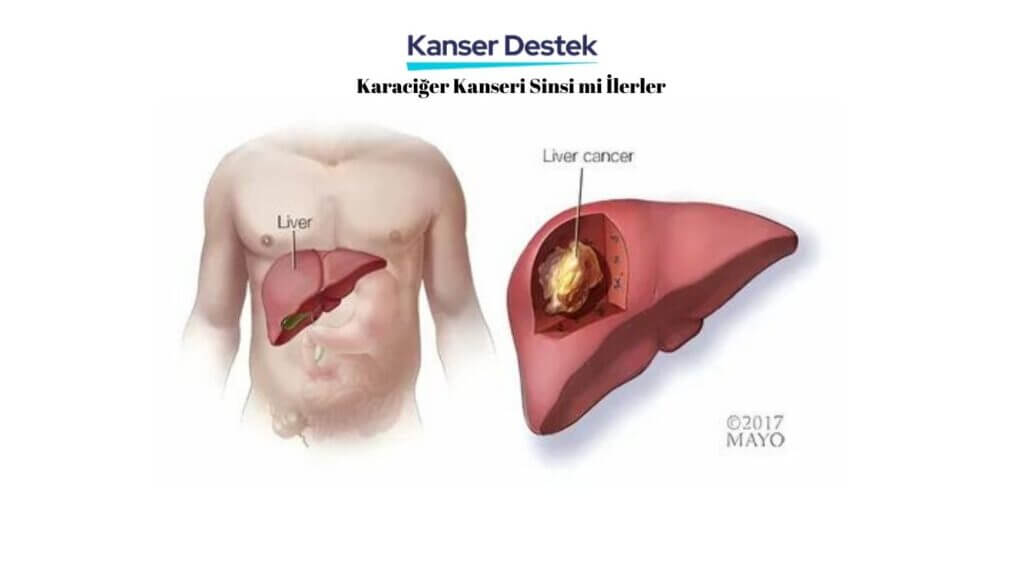 Karaciğer Kanseri Sinsi mi İlerler
