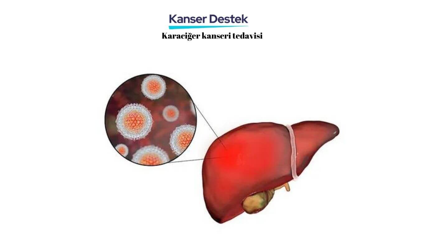 Karaciğer Kanseri Tedavisi ve Dikkat Gerektiren 5 Risk!