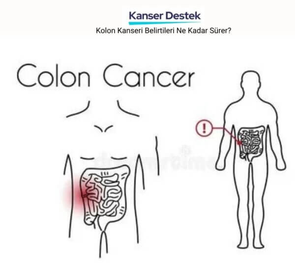 Kolon Kanseri Belirtileri Ne Kadar Sürer