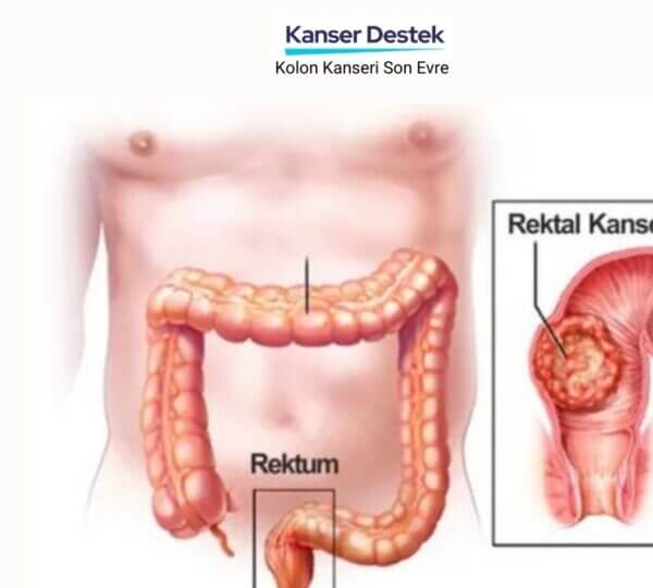 Kolon Kanseri Son Evre