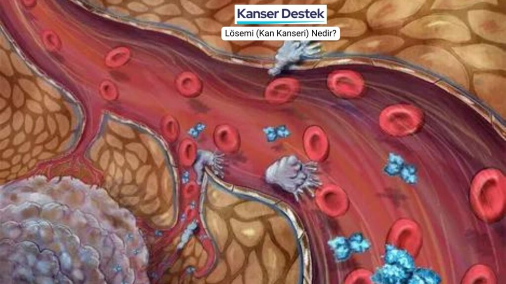 Lösemi (Kan Kanseri) Nedir?