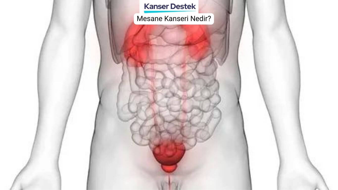 Mesane Kanseri Nedir? İşte 4 Önemli Belirtisi