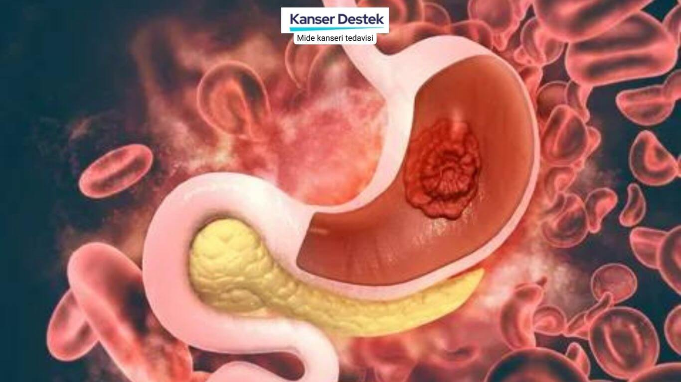 Mide Kanseri Tedavisi ve Ameliyat Sonrası İyileşme Süreci