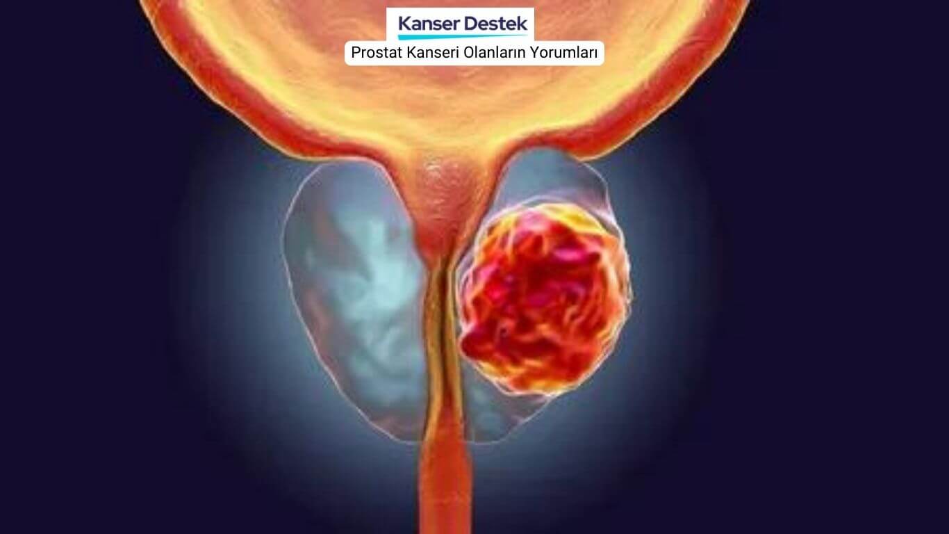 Prostat Kanseri Olanların Yorumları Neler?