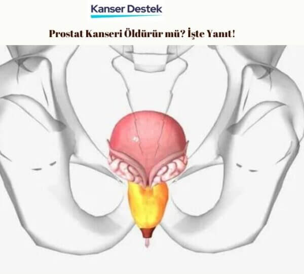 prostat-kanseri-oldururmu