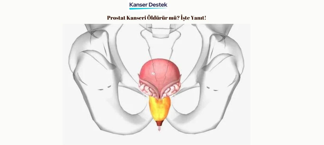 Prostat Kanseri Öldürürmü?
