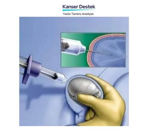 Testis Tümörü Ameliyatı