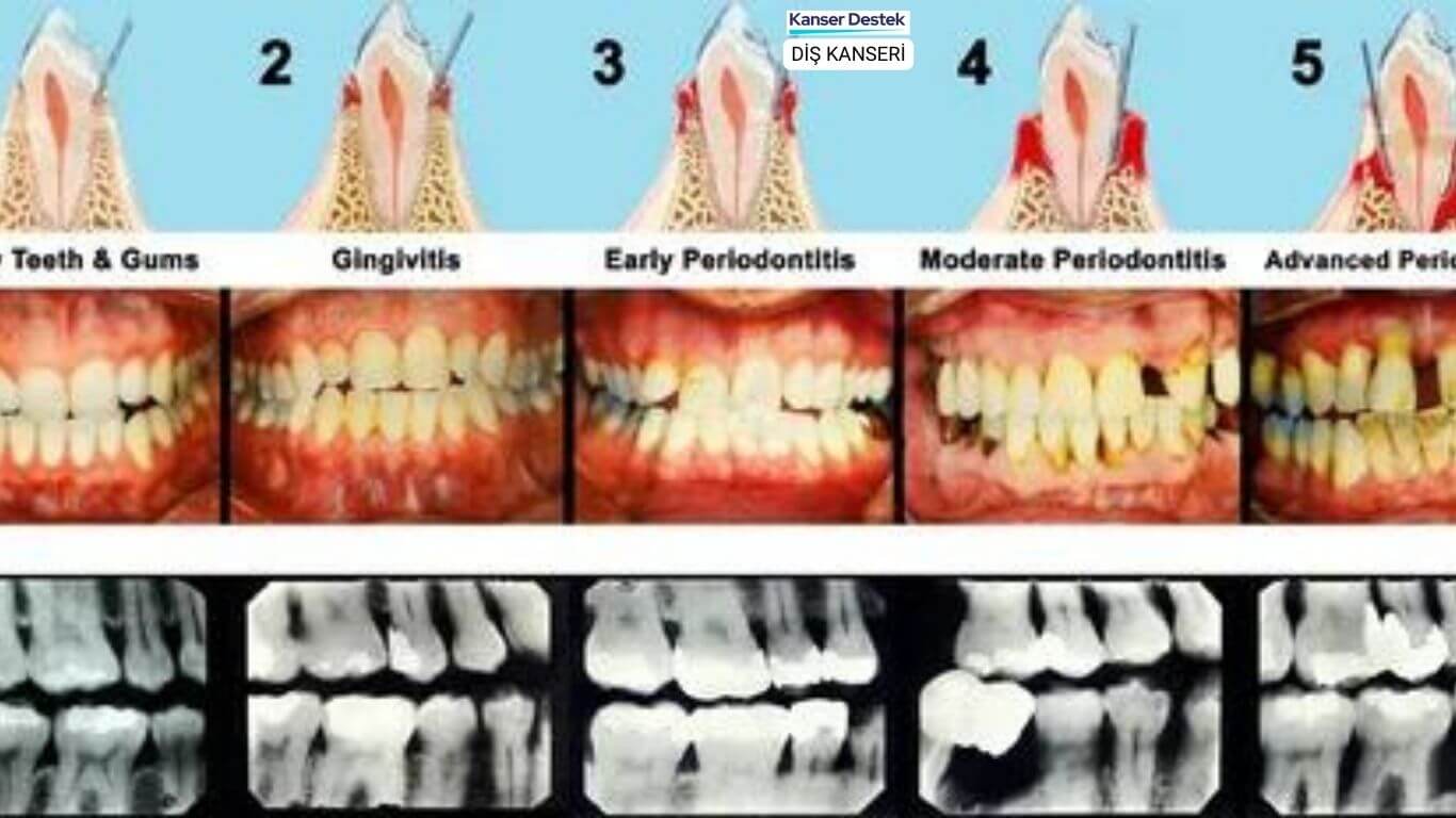 8 Diş Kanseri Belirtisi ve Özel Tedavi Yöntemleri