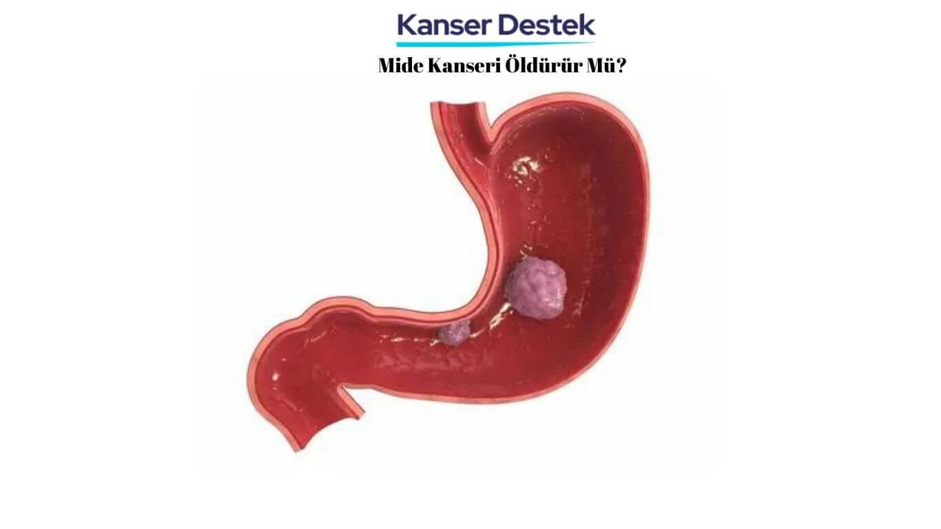 Mide Kanseri Öldürür Mü?