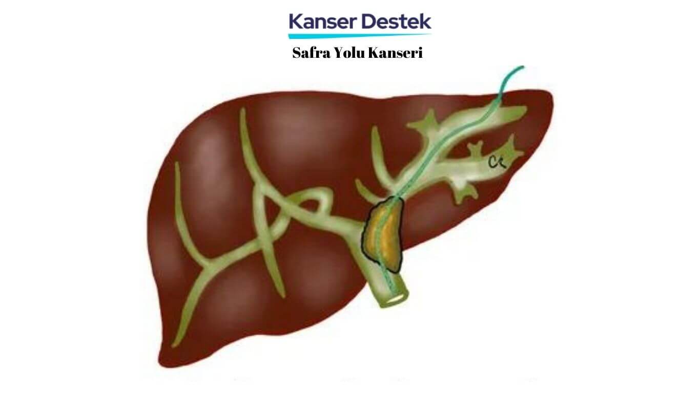 Safra Yolu Kanseri  ve Sebep Olan 7 Tehlikeli Durum!
