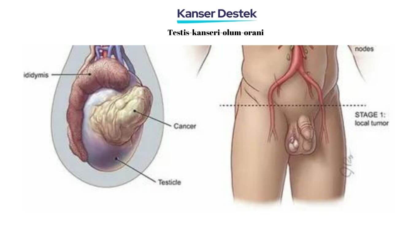 3 Özel Cevap İle Testis Kanseri Ölüm Oranı!